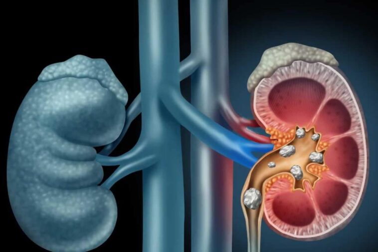 Silent Stone In Kidneys Can Cause Organ Failure, Expert Weighs In